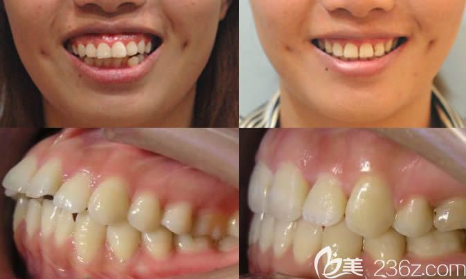 泉州維樂口腔楊華牙齒正畸效果前后對比