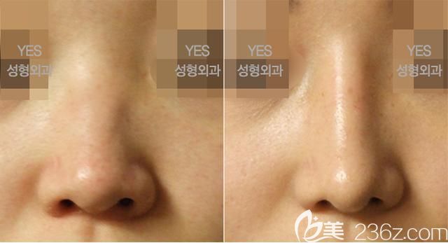 韓國(guó)yes隆鼻案例 韓國(guó)yes隆鼻案例