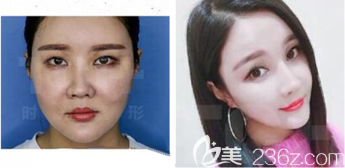 重慶時光做面部線雕效果怎么樣