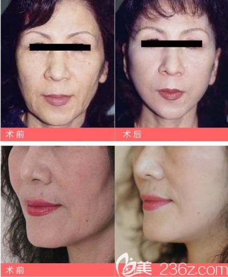 傅天祥博士線雕案例