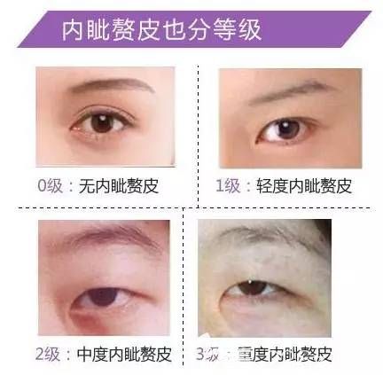 內(nèi)資贅皮需要做開眼角手術(shù) 內(nèi)資贅皮需要做開眼角手術(shù)