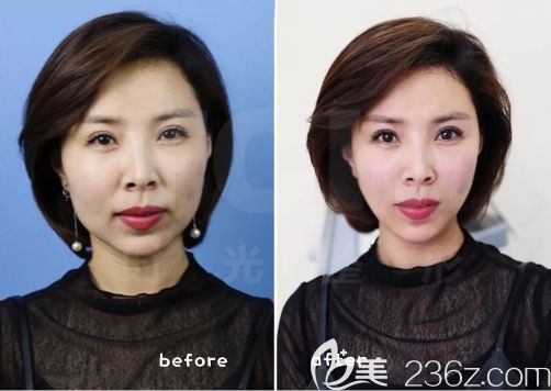 重慶時光整形面部線雕案例