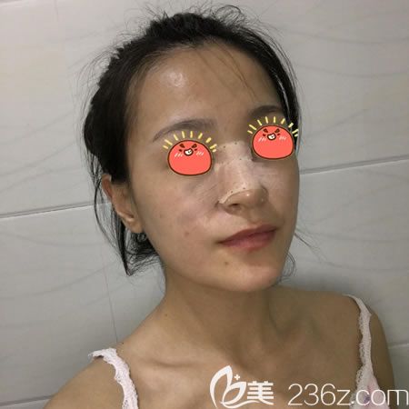 紹興藝美剛做完假體隆鼻的<span style=