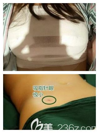 我在南寧華美做腰腹部吸脂加隆胸術(shù)后第2天
