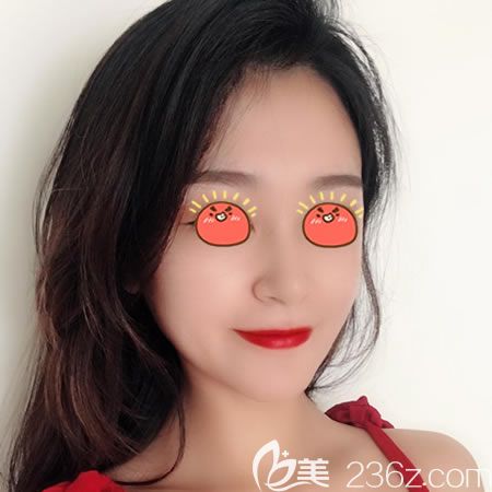 過完年在紹興藝美做的硅膠假體隆鼻手術(shù),現(xiàn)在把恢復3個月效果和價格分享給大家