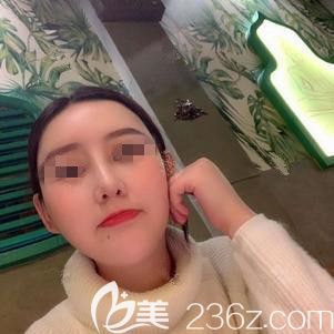 在保定藍山做鼻綜合術(shù)后20天鼻子變高挺 在保定藍山做鼻綜合術(shù)后20天鼻子變高挺