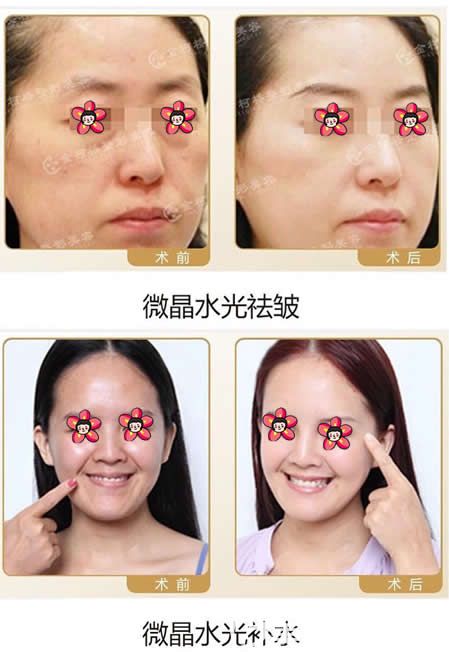 醫(yī)院余洪斌微晶水光美膚案例