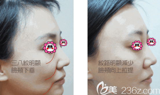 北京華韓藍紹梓6D鉆石線雕縱+橫全方位逆齡案例