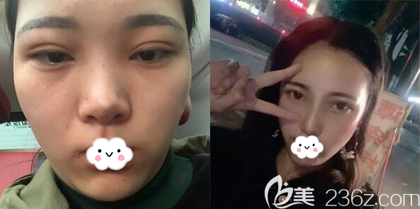 成都成美李靜鼻綜合術(shù)后15天對(duì)比照片