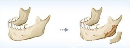 上海愉悅美聯(lián)臣醫(yī)療美容醫(yī)院金振珸下頜角磨骨和削骨的區(qū)別 上海愉悅美聯(lián)臣醫(yī)療美容醫(yī)院金振珸下頜角磨骨和削骨的區(qū)別