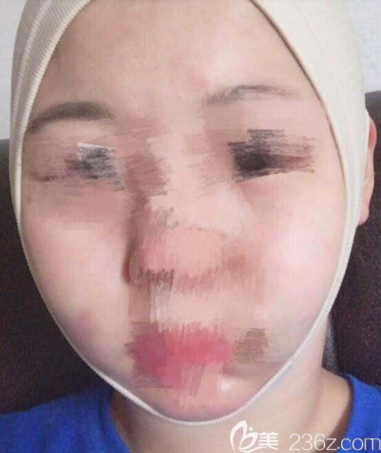 剛做完手術的我 剛做完手術的我