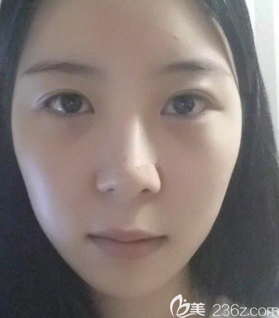 韓國遇見美李承燦做輪廓怎么樣 韓國遇見美李承燦做輪廓怎么樣