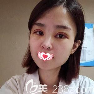 在保定藍(lán)山做眼綜合術(shù)后7天進(jìn)行拆線 在保定藍(lán)山做眼綜合術(shù)后7天進(jìn)行拆線