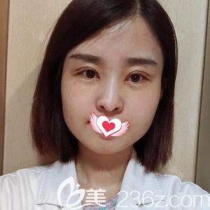 王儉醫(yī)生為我做眼綜合術(shù)后18天慢慢消腫 王儉醫(yī)生為我做眼綜合術(shù)后18天慢慢消腫