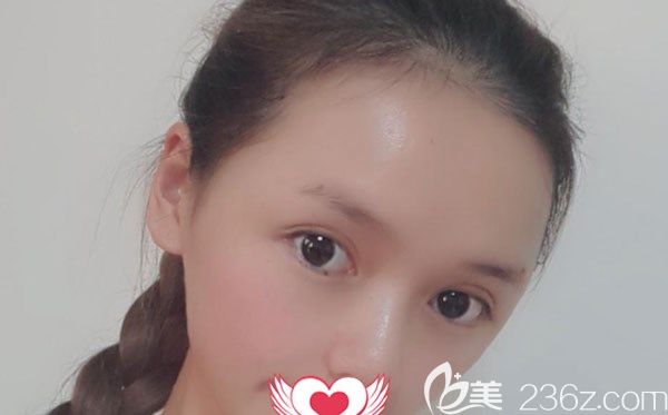 自體脂肪填充太陽穴第7天拆線沒有感到疼痛