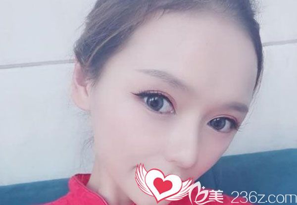 脂肪移植填充太陽穴20天脂肪存活率比較高