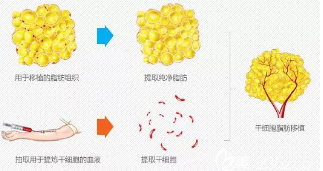 脂肪填充過程 脂肪填充過程