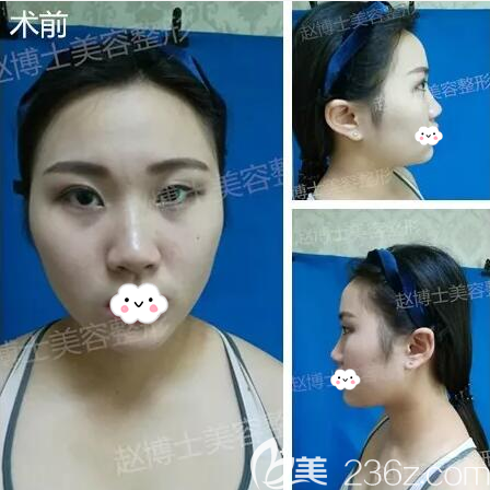 成都軍大整形外科醫(yī)院趙善軍術(shù)前照片1