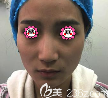 在北京壹加壹做隆鼻前樣子 在北京壹加壹做隆鼻前樣子