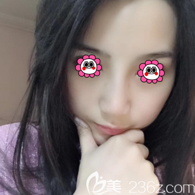 張曉亮醫(yī)生給我做假體隆鼻半個月效果 張曉亮醫(yī)生給我做假體隆鼻半個月效果