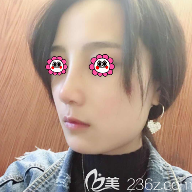 在北京壹加壹做隆鼻第36天樣子 在北京壹加壹做隆鼻第36天樣子