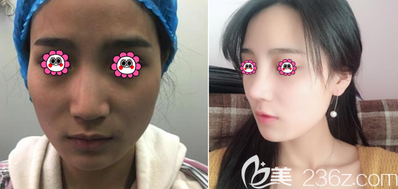 北京壹加壹隆鼻前后對比效果 北京壹加壹隆鼻前后對比效果