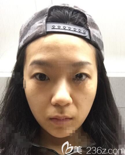 韓國JK整形做眼睛怎么樣 韓國JK整形做眼睛怎么樣