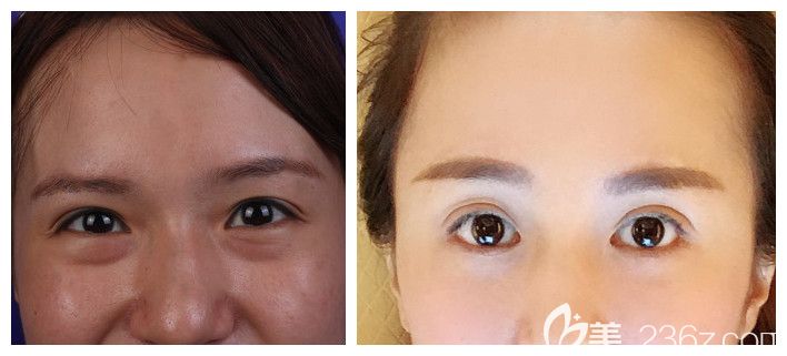 劉駿主任內(nèi)切祛眼袋+割雙眼皮術(shù)后案例展示