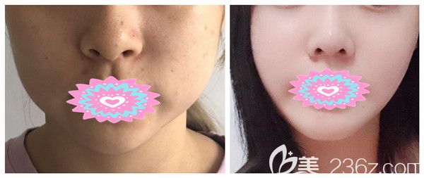 劉駿醫(yī)生瘦臉除皺瘦臉對(duì)比圖