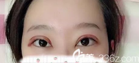 包頭葉子<!--<i data=20240703-sp></i>-->全切雙眼皮第二天圖片 包頭葉子<!--<i data=20240703-sp></i>-->全切雙眼皮第二天圖片