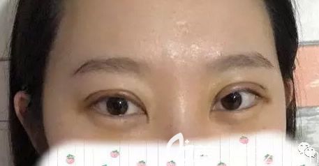 切開雙眼皮第五天效果好不好 切開雙眼皮第五天效果好不好