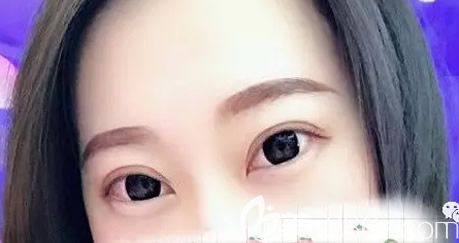 親身經(jīng)歷后才知道包頭葉子做雙眼皮怎么樣 我還拍了包頭葉子整形價格表