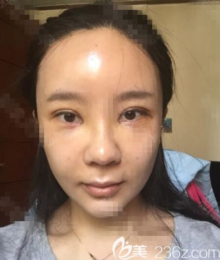 韓國JK脂肪填充真人案例 韓國JK脂肪填充真人案例