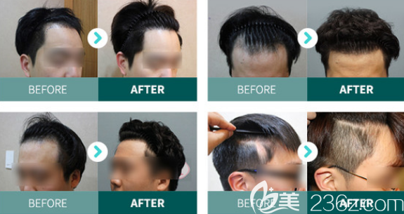 韓國moplus發(fā)際線種植、疤痕種植<span style=