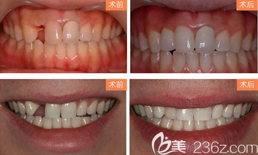 寧波薇琳齒科<!--<i data=20240703-sp></i>-->勝種植牙案例 寧波薇琳齒科<!--<i data=20240703-sp></i>-->勝種植牙案例