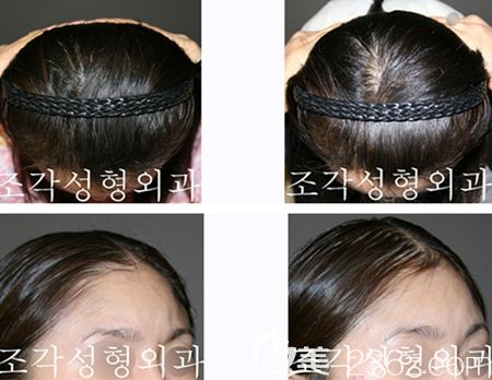 韓國雕刻骨水泥填充案例 韓國雕刻骨水泥填充案例