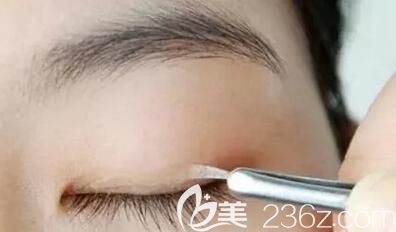 貼雙眼皮貼是導(dǎo)致多眼皮的原因之一