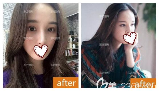  原本只是找南寧東方整形院長(zhǎng)做肋軟骨鼻綜合隆鼻,面診后又加了全切雙眼皮