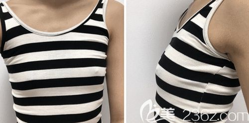 在韓國(guó)瑪博爾做假體隆胸手術(shù)前 在韓國(guó)瑪博爾做假體隆胸手術(shù)前