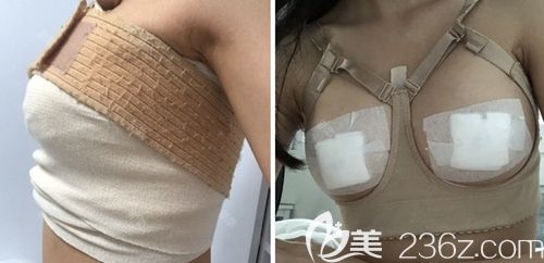 在韓國(guó)瑪博爾做假體隆胸手術(shù)當(dāng)天 在韓國(guó)瑪博爾做假體隆胸手術(shù)當(dāng)天