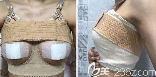 在韓國(guó)瑪博爾做假體隆胸手術(shù)后2周 在韓國(guó)瑪博爾做假體隆胸手術(shù)后2周