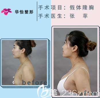 假體隆胸前后對(duì)比照片