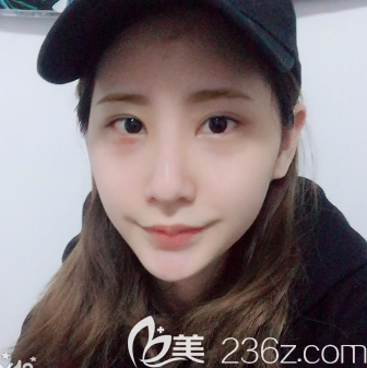 廣州紫馨谷琪祛眼袋術(shù)后三天 廣州紫馨谷琪祛眼袋術(shù)后三天