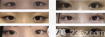 韓國(guó)樂(lè)于麗顏?lái)n式雙眼皮案例