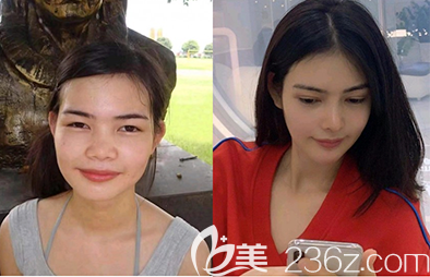 韓國(guó)樂(lè)于麗顏整形外科韓式隆鼻照片對(duì)比圖