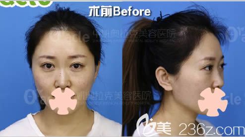 我在中妍奧拉克做鼻綜合的術(shù)前照 我在中妍奧拉克做鼻綜合的術(shù)前照
