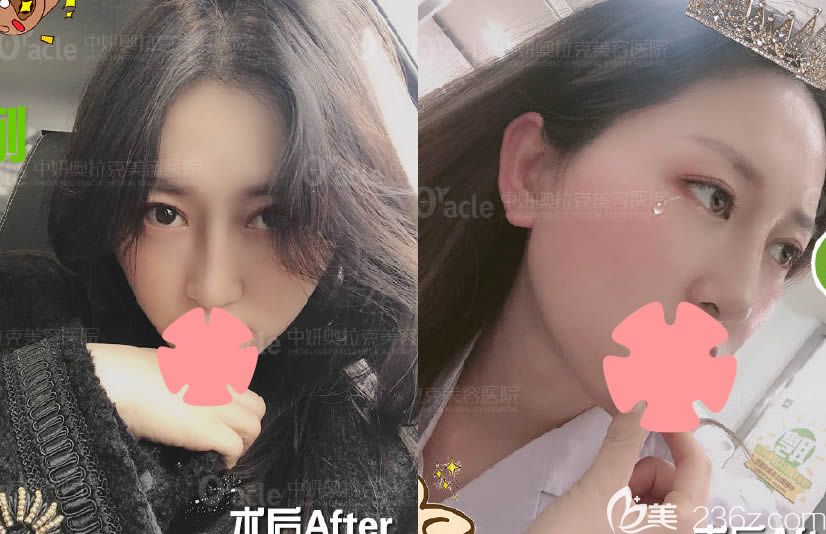 和閨蜜同時(shí)在長(zhǎng)春中妍奧拉克做的鼻綜合隆鼻，大家看看我倆誰的效果更好呢