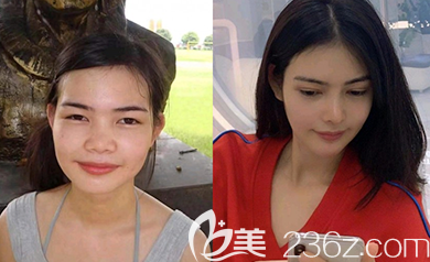 韓國樂于麗顏金范鎮(zhèn)院長韓式隆鼻案例效果對比圖 韓國樂于麗顏金范鎮(zhèn)院長韓式隆鼻案例效果對比圖