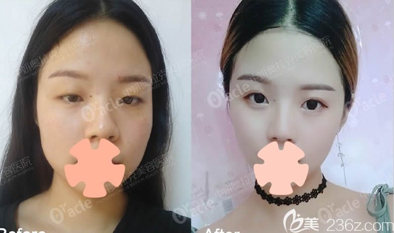 閨蜜在中妍奧拉克做的鼻子整形前后對(duì)比照 閨蜜在中妍奧拉克做的鼻子整形前后對(duì)比照