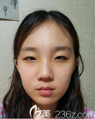 韓國樂于麗顏整形做的眼綜合案例 韓國樂于麗顏整形做的眼綜合案例